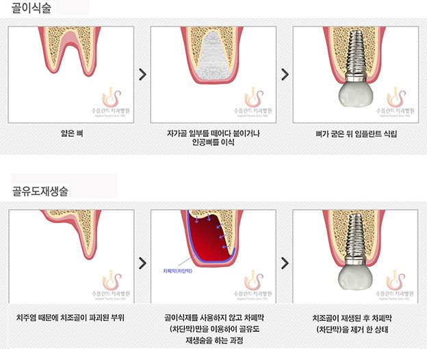 임플란트