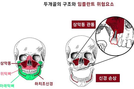 임플란트