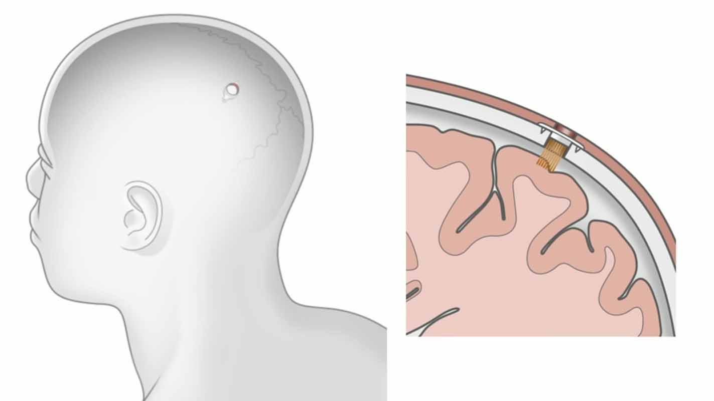 ▲뉴럴링크가 개발한 브레인칩의 이식 방식. ⓒneuralink.com 캡처