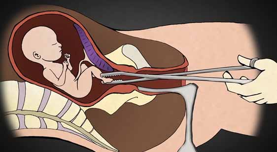 ▲어머니의 자궁 안에 있는 태아를 기구를 사용해서 강제로 낙태시키는 모습. ⓒ2nd Trimester Medical Abortion
