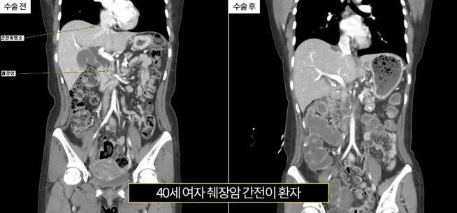 췌장암 간전이